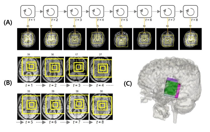 A. 세브란스병원 ASD 환자의 MRI 빅데이터에서 인공지능 모델이 자폐 중증도와 관련된 뇌 주요 부위들의 연관 관계를 찾아내는 모습.B. 국제컨소시엄으로 구축된 1000여 건의 자폐증 환자 MRI 빅데이터에서 인공지능 모델이 자폐 중증도와 관련된 뇌 주요 부위들의 연관 관계를 찾아내는 모습.C. A와 B의 주요 부위를 3차원으로 표현한 뇌 이미지.