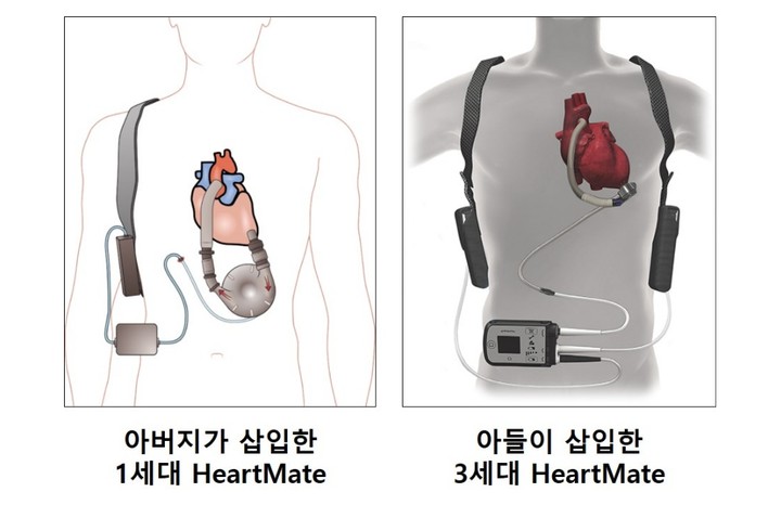 아버지 아들 HeartMate 비교 ©세브란스병원