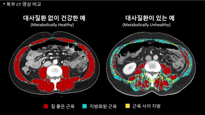 대사질환 없이 건강한 사람과 그렇지 못한 사람의 복부 CT 영상 비교 ©서울아산병원